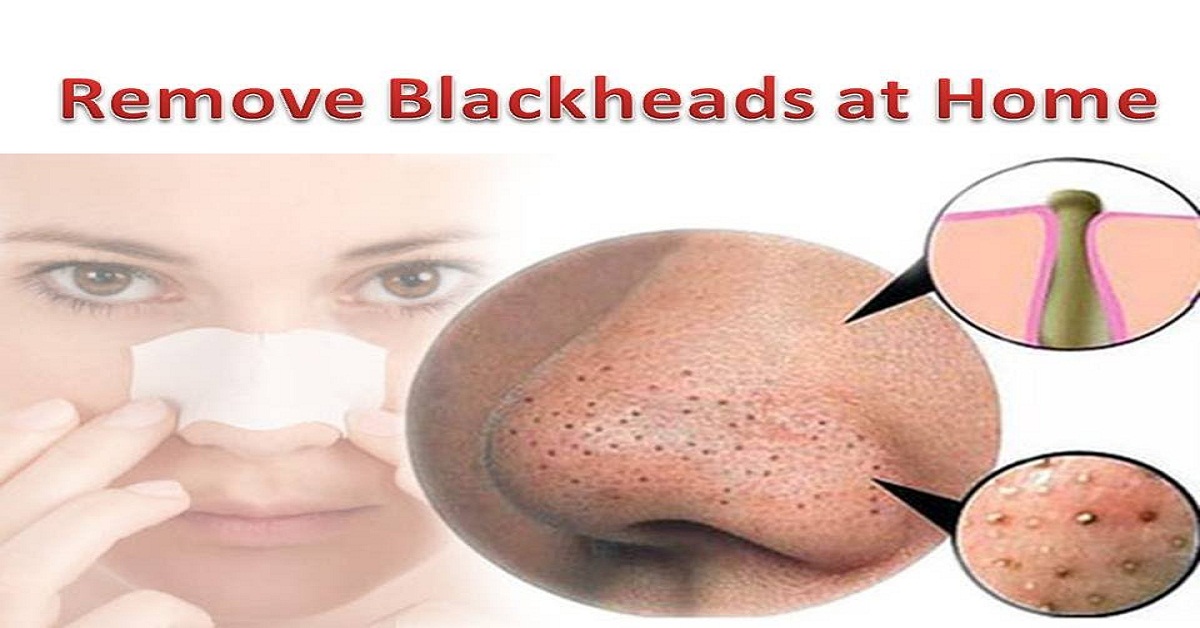 beauty-hacks-how-to-get-rid-of-blackheads-on-the-nose
