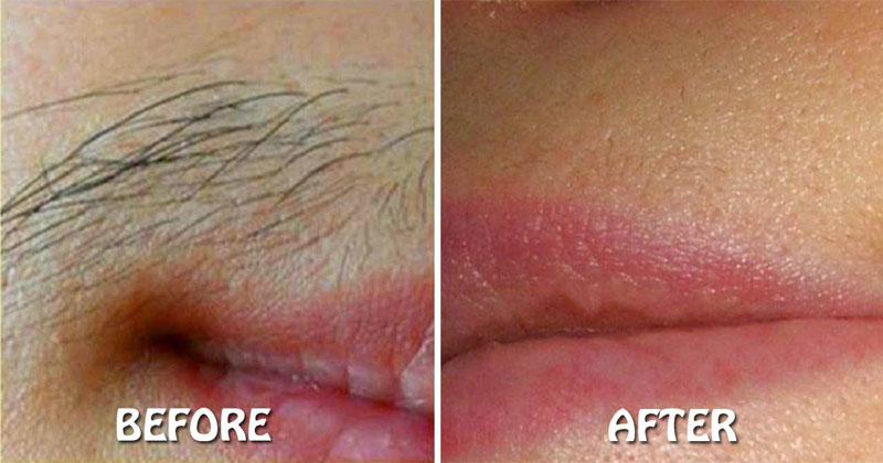 How to remove upper lip hair naturally