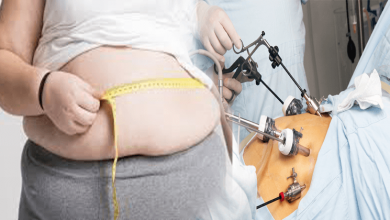 Weight loss operation