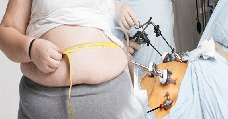 Weight loss operation