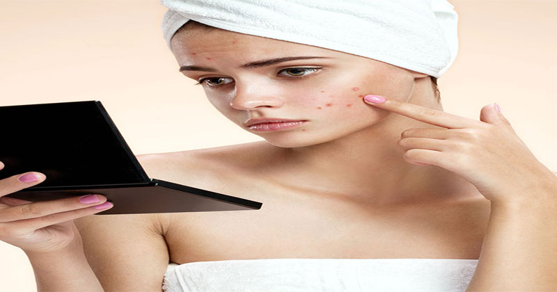 How-to-get-rid-of-Pimples