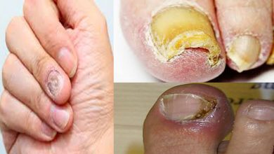 Try-these-home-remedies-for-nail-fungus