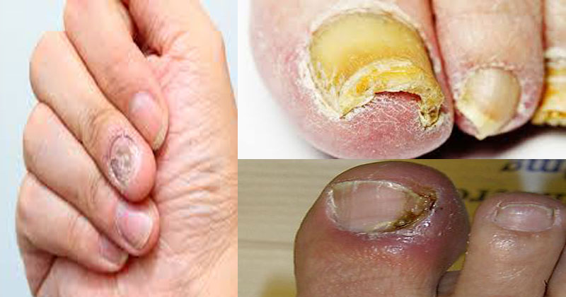 Try-these-home-remedies-for-nail-fungus