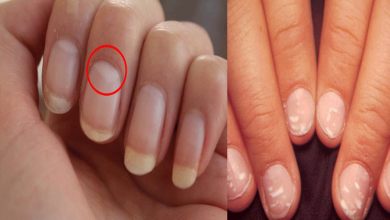 White-spots-on-nails