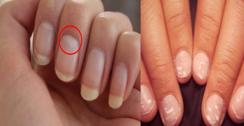 White-spots-on-nails