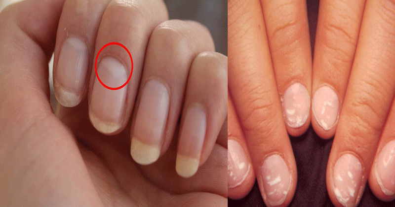 White-spots-on-nails