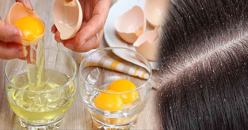 Natural-Home-Remedy-For-Dandruff